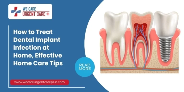 How to Treat Dental Implant Infection at Home, Effective Home Care Tips