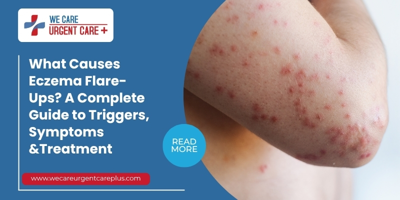 What Causes Eczema Flare-Ups A Complete Guide to Triggers, Symptoms &Treatment