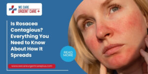 Is Rosacea Contagious Everything You Need to Know About How It Spreads
