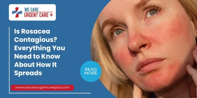 Is Rosacea Contagious Everything You Need to Know About How It Spreads