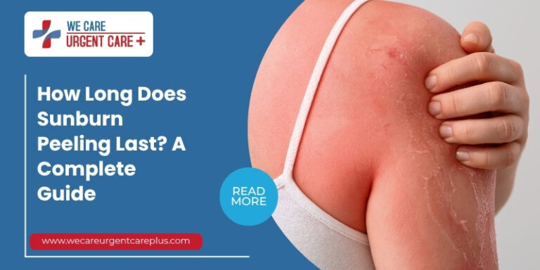 How Long Does Sunburn Peeling Last A Complete Guide
