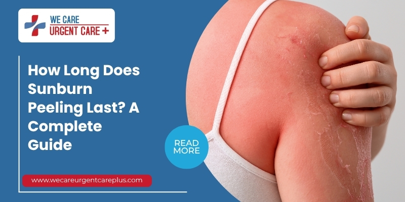 How Long Does Sunburn Peeling Last A Complete Guide